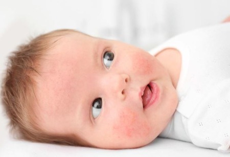 حساسیت به گندم در شیرخواران