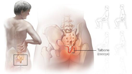 درد دنبالچه, علت درد دنبالچه