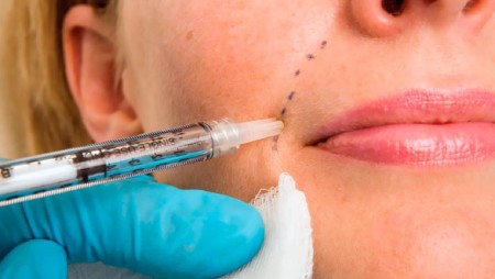 نکات مراقبتی بعد از تزریق ژل و فیلر