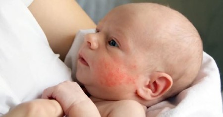 مدیریت اگزما در نوزادان