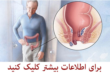 جراحی هموروئید,جراحی بواسیر,جراحی بواسیر با لیزر