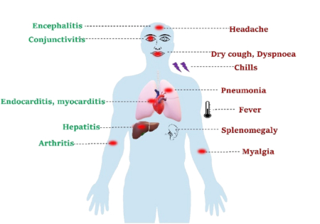 تب طوطی, درمان تب طوطی در انسان