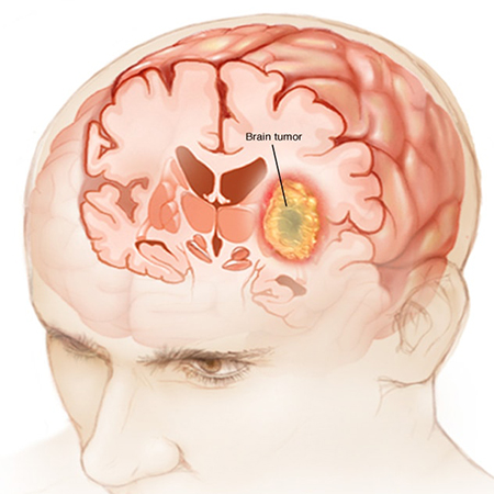 غده صنوبری, پاکسازی غده صنوبری, درمان کیست غده صنوبری