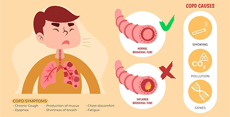 پیشگیری از بیماری مزمن انسدادی ریه, نشانه های بیماری copd