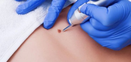 فریز درمانی یا کرایوتراپی پوست