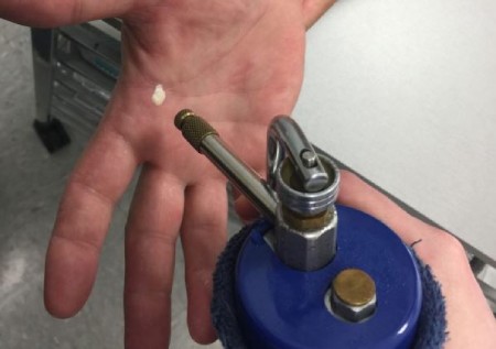 معایب فریز درمانی پوست