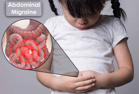 میگرن شکمی, علائم میگرن شکمی در کودکان