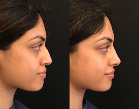 کوچک کردن بینی با زنجبیل