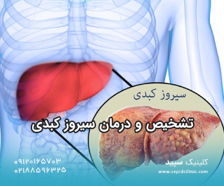 تشخیص و درمان سیروز کبدی با فیبرو اسکن