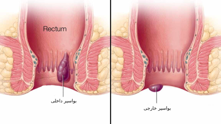 بیماری بواسیر, بیماری هموروئید