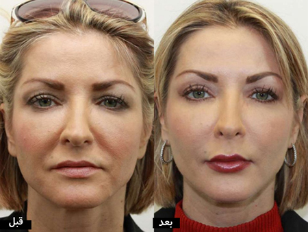 انتقال چربی،تزریق چربی،کاهش چربی زیر پوست،مزایای تزریق چربی