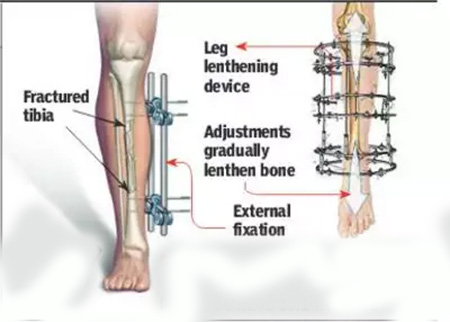 سؤالات متداول عمل افزایش قد, مراقبت‌های پس از عمل افزایش قد, محل برش و میله در بدن 