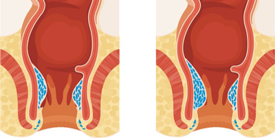 بیماری بواسیر, بیماری هموروئید