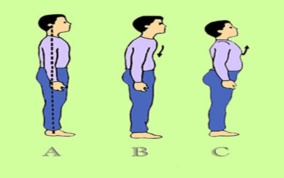ناهنجاری قامتی,نحوه صحیح ایستادن,ناهنجاری های اسکلتی