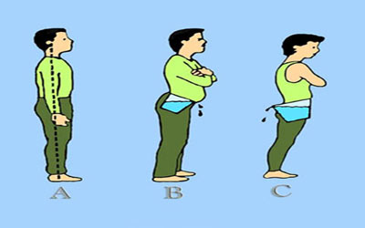 ناهنجاری قامتی,نحوه صحیح ایستادن,ناهنجاری های اسکلتی