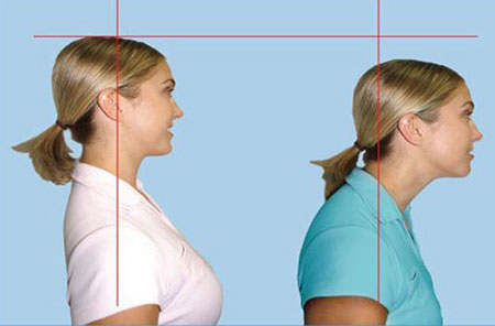 چگونه قوز کمر رو از بین ببریم, درمان قوز و افتادگی شانه, درمان قوز کمر