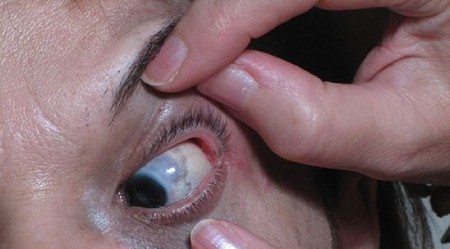 علت خال اوتا