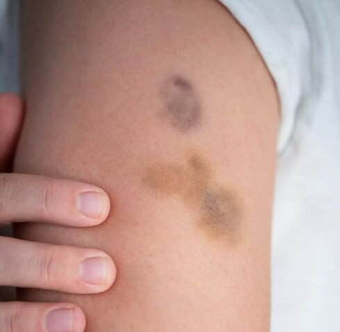 سرطان‌ها,اخبار پزشکی ,خبرهای پزشکی