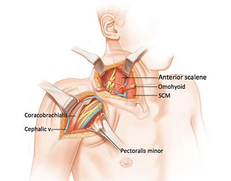 آسیب شبکه بازویی, آسیب شبکه بازویی چیست, درمان آسیب‌های شبکه بازویی