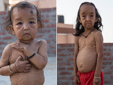 بیماری کوتیس لاکسا, عوامل خطرساز بیماری کوتیس لاکسا, نشانه های بیماری کوتیس لاکسا