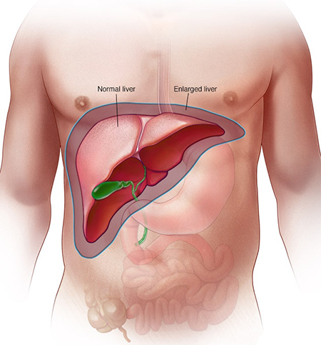 درد کبد, علائم درد کبد چرب