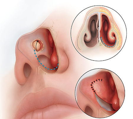 سوراخ شدن تیغه بینی, سوراخ شدن تیغه بینی بعد از عمل, مصرف مواد مخدر یکی از علل سوراخ شدن تیغه بینی