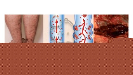 عوارض اسلیو معده