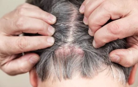 علائم ترک پوست سر