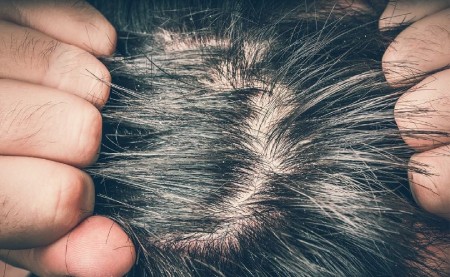 تشخیص ترک پوست سر