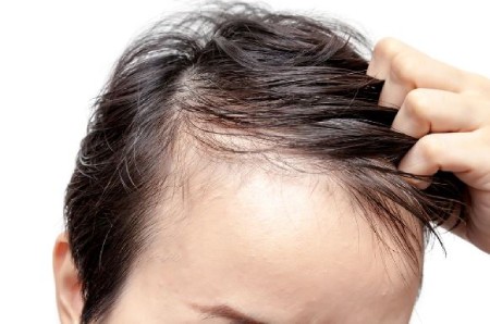 درمان ترک پوست سر
