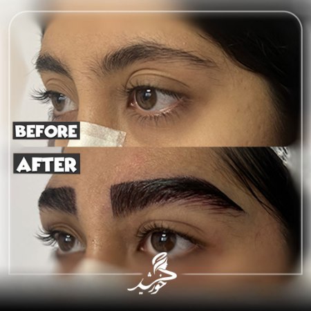 نمونه-کاشت-ابرو-کلینیک-خورشید