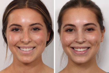 مدل جراحی بینی طبیعی, مدل جراحی بینی طبیعی برای بینی استخوانی