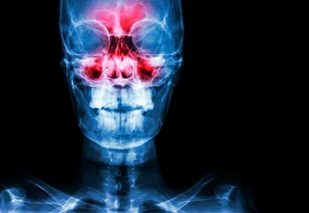 سرطان بینی, سرطان سینوس