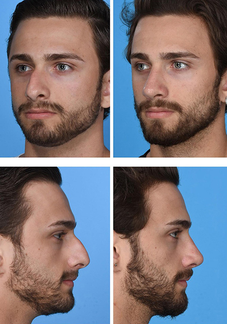 مدل جراحی بینی مردانه, عمل بینی طبیعی مردانه