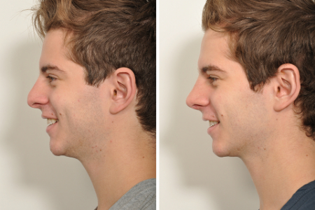 مدل جراحی بینی مردانه, عمل بینی طبیعی مردانه