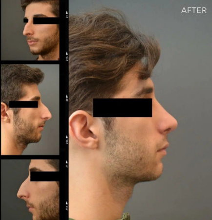 مدل جراحی بینی مردانه, عمل بینی طبیعی مردانه