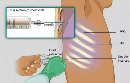 آنالیز مایع جنب, نحوه انجام آزمایش مایع جنب