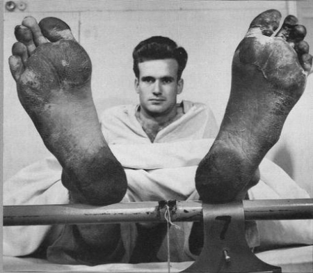 پای سنگرمانده, بیماری پای سربازان