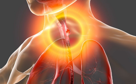 آدنوکارسینوما, آدنوکارسینوما روده چیست, سرطان ریه آدنوکارسینوما