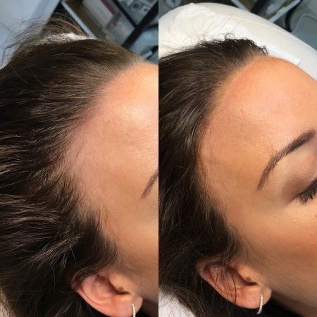 میکروبلیدینگ خط مو