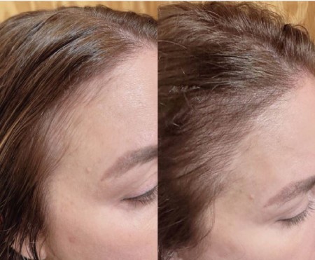 میکروبلیدینگ خط مو