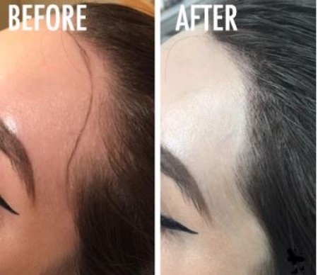 میکروبلیدینگ خط مو