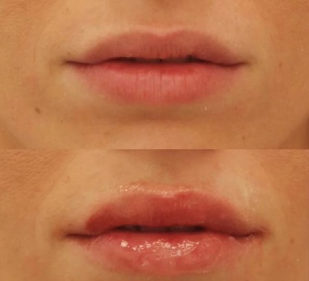 نکات ایمنی در مورد تزریق ژل پاژ