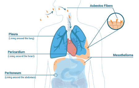 مزوتلیوما, مزوتلیوما بدخیم