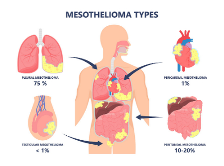 مزوتلیوما, مزوتلیوما بدخیم