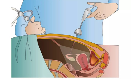 ارکیوپکسی چیست, عوارض ارکیوپکسی