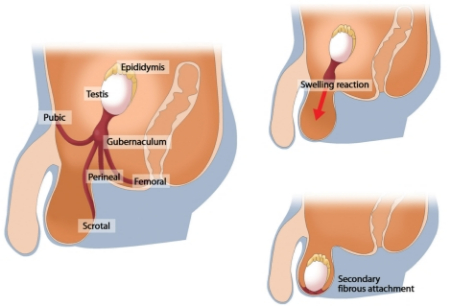 ارکیوپکسی چیست, عوارض ارکیوپکسی