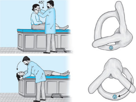 مانور دیکس هالپایک چیست, درمان سرگیجه با مانور دیکس هالپایک