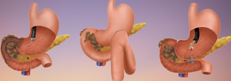 گاستروژیونوستومی چیست, گاستروژژنوستومی لوپ