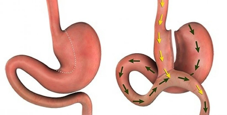 گاستروژیونوستومی چیست, گاستروژژنوستومی لوپ